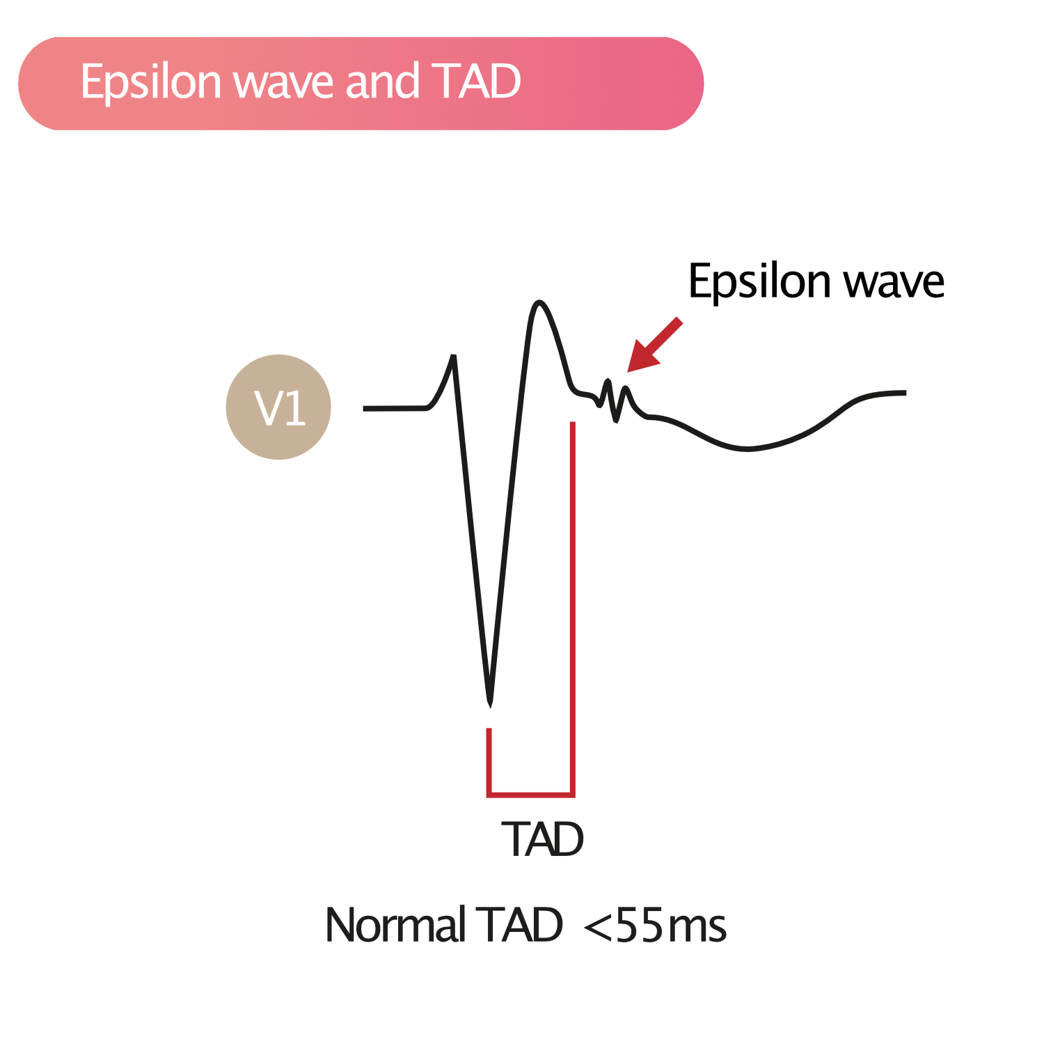 Figure 1. Onde d'Epsilon (flèche) et mesure de la durée d'activation terminale (TAD) sur l'électrocardiogramme en dérivation V1.