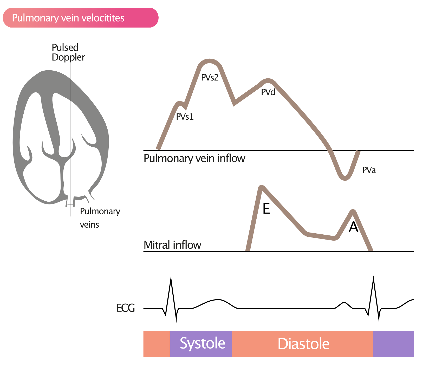 Figure 5. Mesure de la vitesse des veines pulmonaires avec le Doppler pulsé.