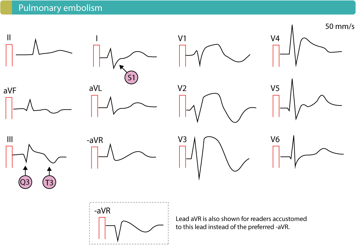 ECG d'embolie pulmonaire avec aspect S1Q3T3 et ondes T négatives antérieures