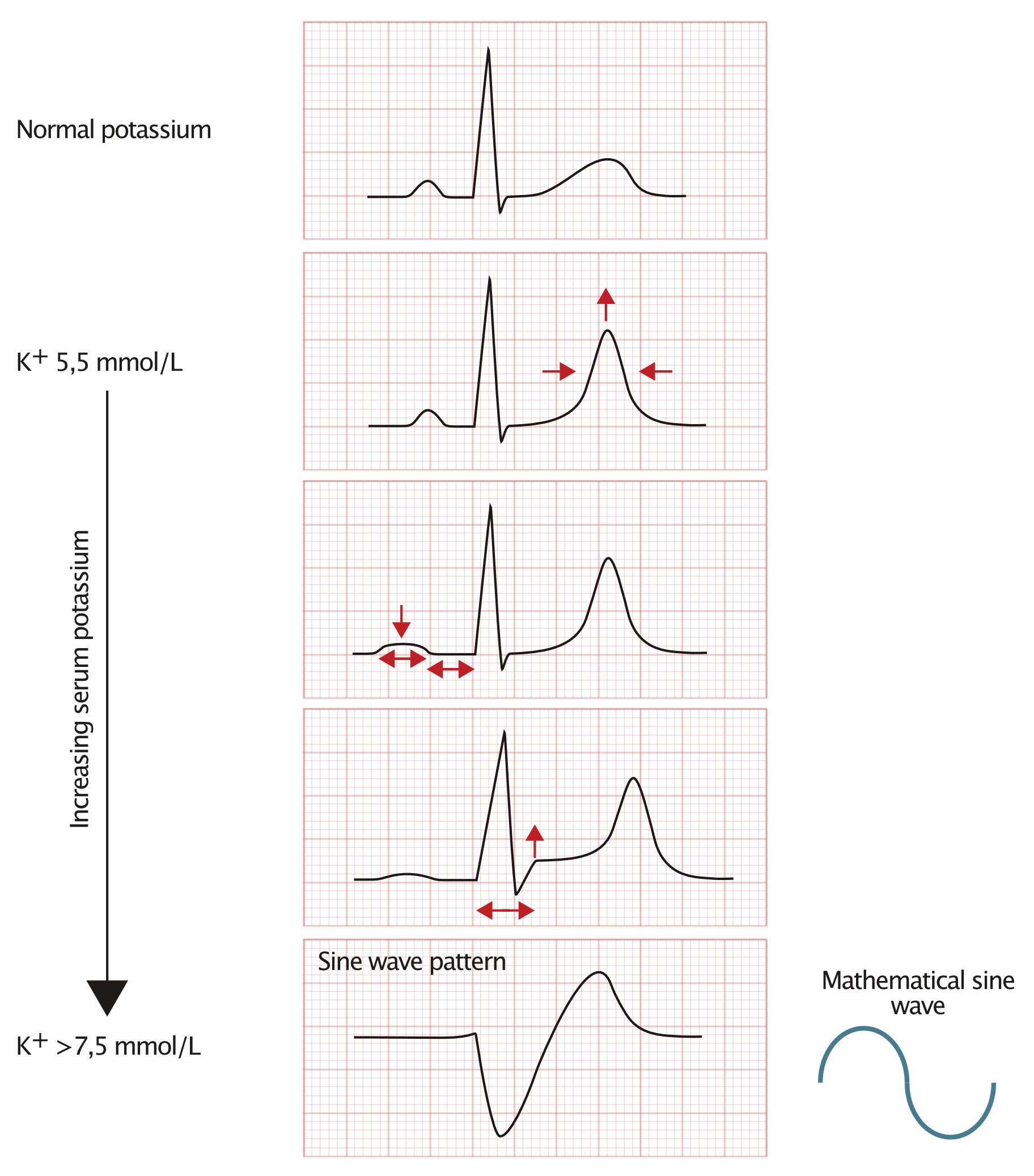 Figure 1. Modifications de l’ECG observées en cas d’hyperkaliémie : progression de l'onde T pointue vers l'élargissement du QRS et l'onde sinusoïdale.