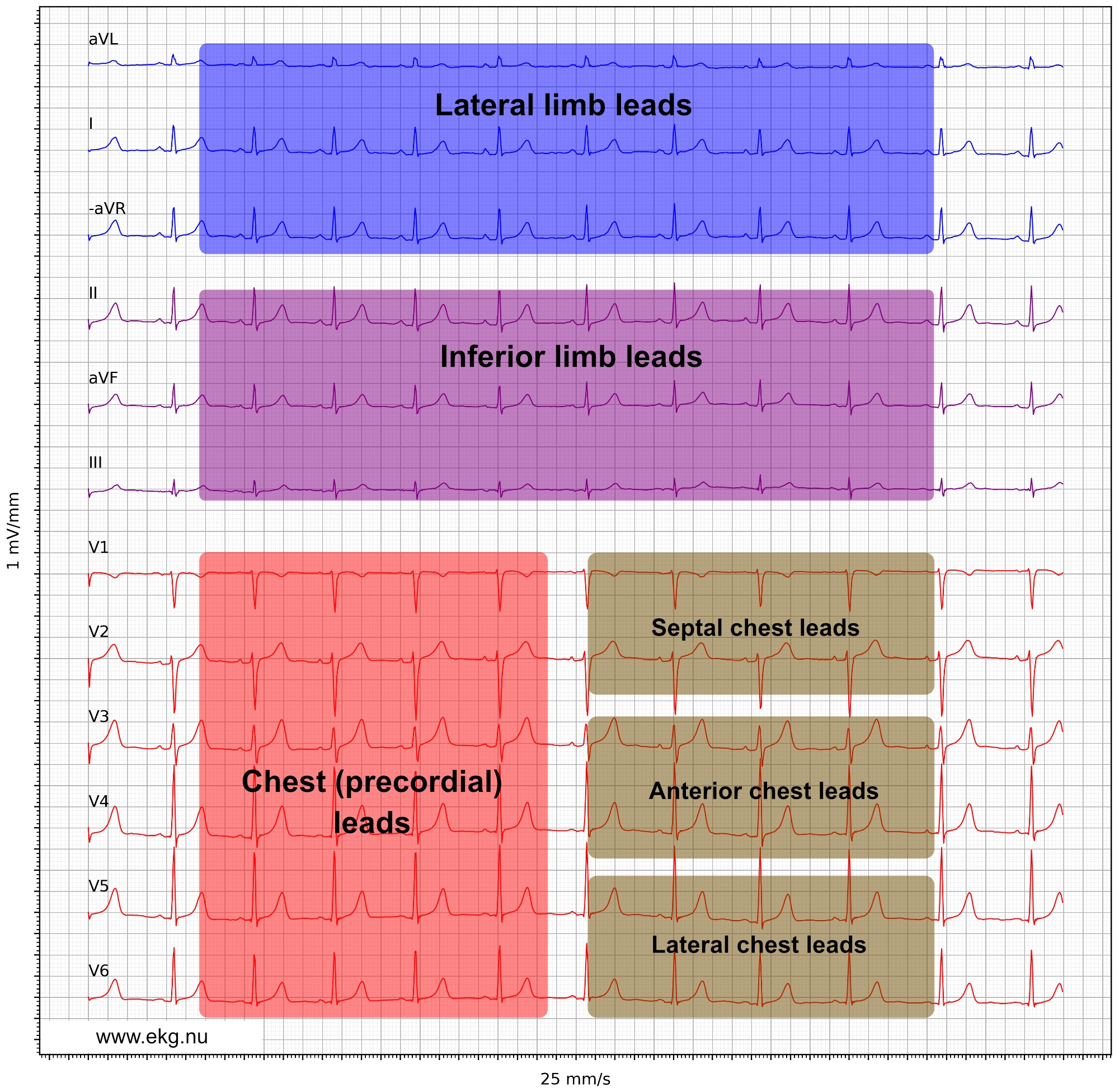 Figure 21. Présentation des dérivations de l’ECG selon le format Cabrera et aVR inversé en -aVR, facilitant la lecture de la contiguïté anatomique.