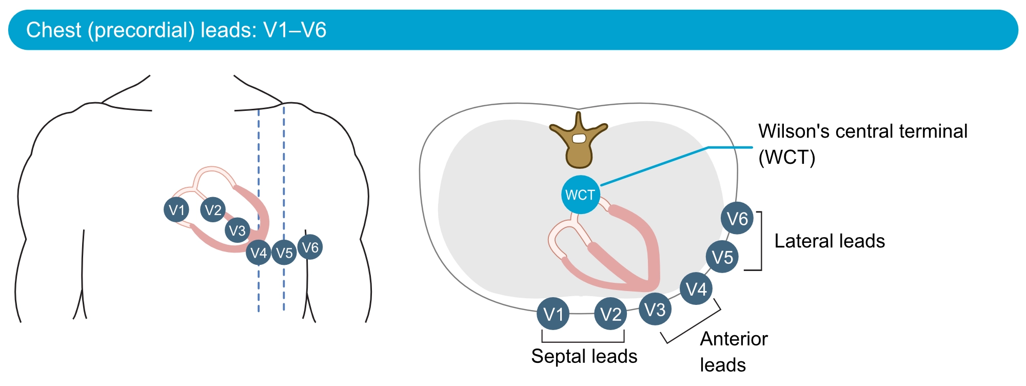 Figure 19. Les dérivations thoraciques (précordiales). WCT = terminal central de Wilson.