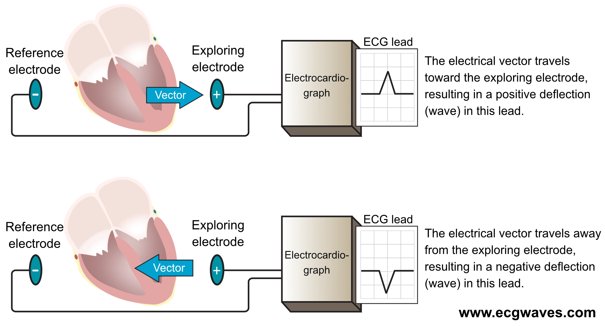 Figure 16. L’électrocardiographe enregistre une dérivation ECG en mesurant la différence de potentiel électrique entre deux points de l’espace. Un vecteur de dépolarisation se dirigeant vers l’électrode exploratrice génère une déflexion positive (vers le haut) sur le tracé, tandis qu'un vecteur s'éloignant produit une déflexion négative (vers le bas).