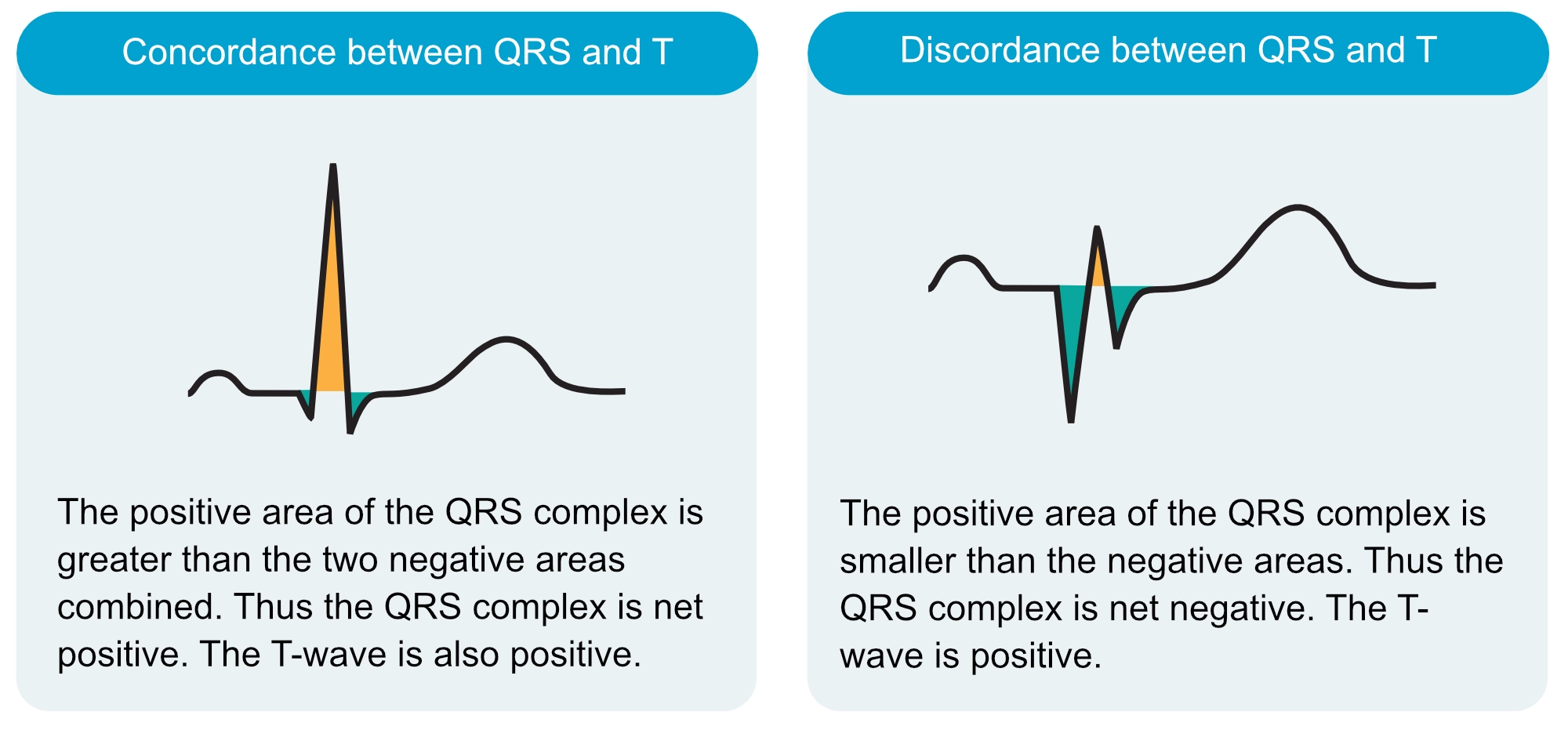 Figure 8. Présentation des ondes T concordantes et discordantes.