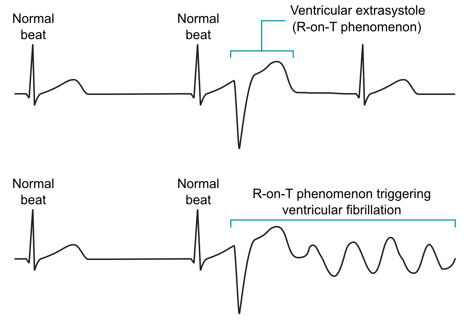 Figure 3. Phénomène R-on-T