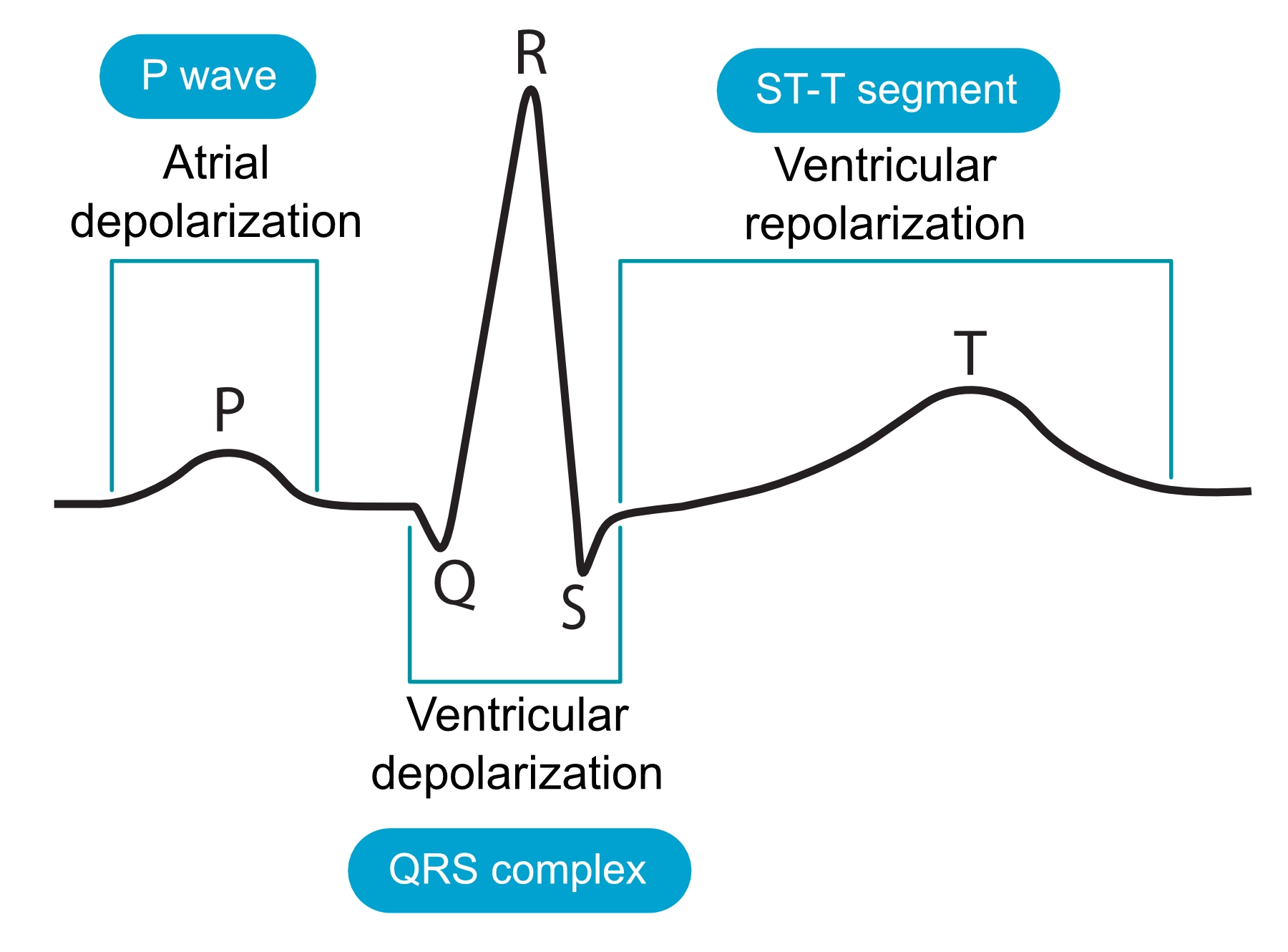 Figure 4. Courbe électrocardiographique typique et événements cardiaques correspondants. Le tracé présenté illustre un complexe QRS, constitué des ondes Q, R et S. Même en l’absence d’une ou de plusieurs de ces ondes, l’ensemble est néanmoins désigné sous le terme de complexe QRS.