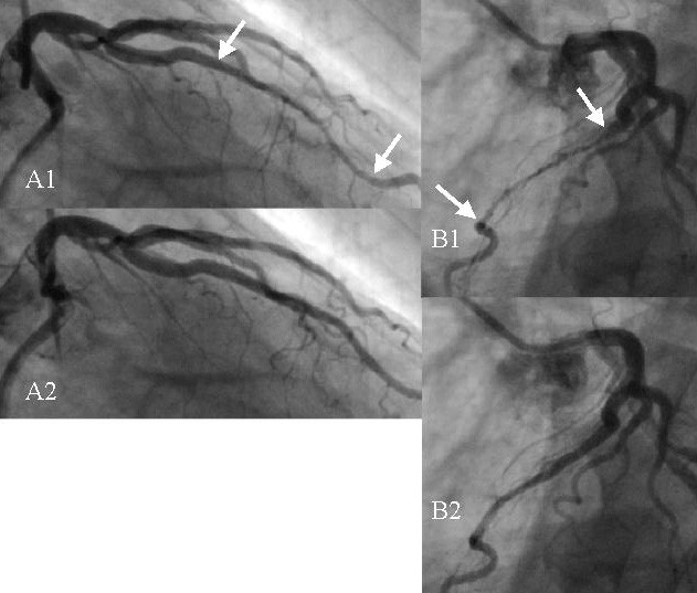 Figure 1. Pont myocardique