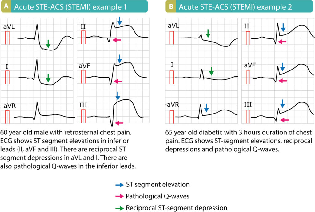 Onde Q Pathologique Ecg Signes Ecg Infarctus LIHS — free download