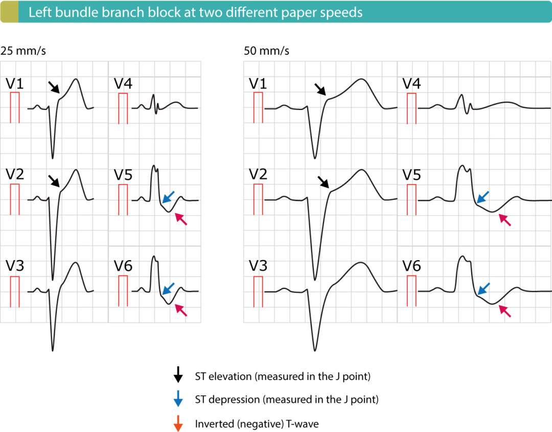 Bloc de branche gauche (BBG) Critères ECG, causes, prise en charge Bloc de branche gauche (BBG) Critères ECG, causes, prise en charge