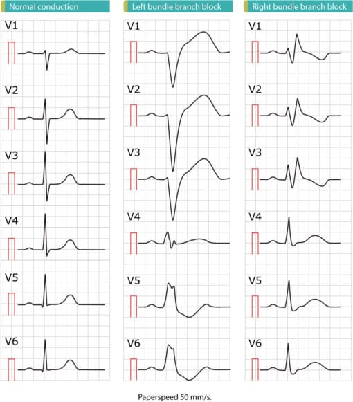 Bloc de branche gauche (BBG) Critères ECG, causes, prise en charge Bloc de branche gauche (BBG) Critères ECG, causes, prise en charge