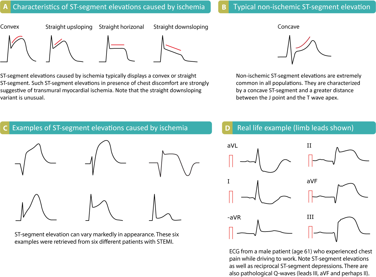 Figure 16. ST segment elevations.