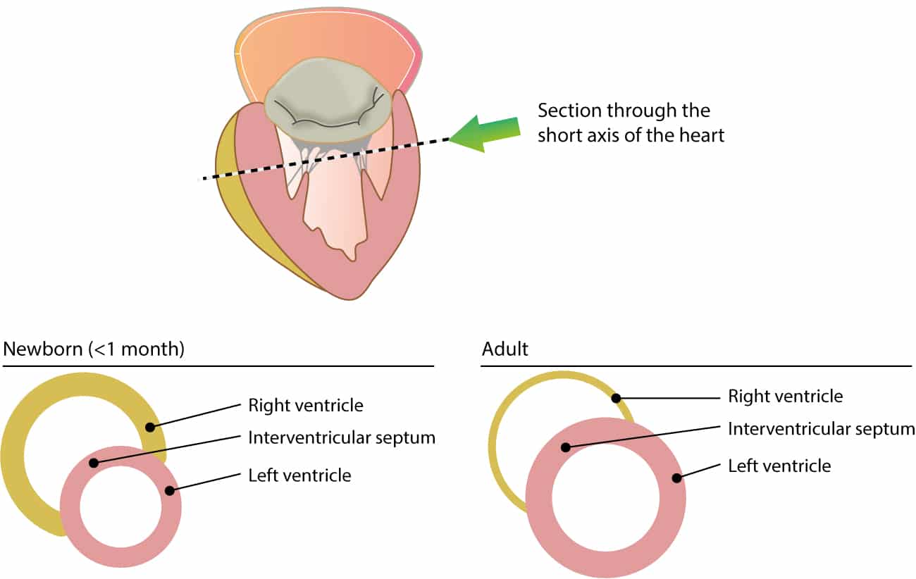 Figure 1. Cross-sectional view of ventricular wall thickness in children (<1 months old) and adults.